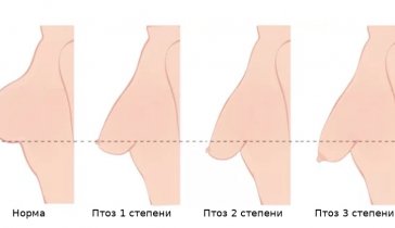 Операция груди (птоз молочной железы)