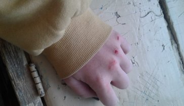 Лечение ребёнка